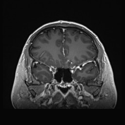 Cerebral arteriovenous malformation (Radiopaedia 84015-99245 Coronal T1 C+ 52).jpg