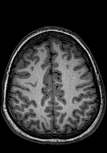 Cerebral arteriovenous malformation at posterior body of corpus callosum (Radiopaedia 74111-84925 Axial T1 67).jpg