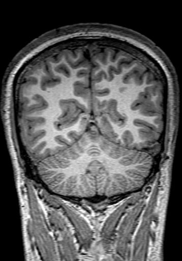 Cerebral arteriovenous malformation at posterior body of corpus callosum (Radiopaedia 74111-84925 Coronal T1 263).jpg