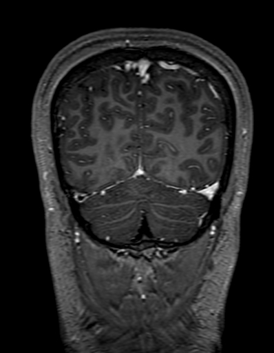 Cerebral arteriovenous malformation at posterior body of corpus callosum (Radiopaedia 74111-84925 K 316).jpg