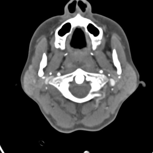 Cerebral arteriovenous malformation with hemorrhage (Radiopaedia 28773-29073 A 53).jpg