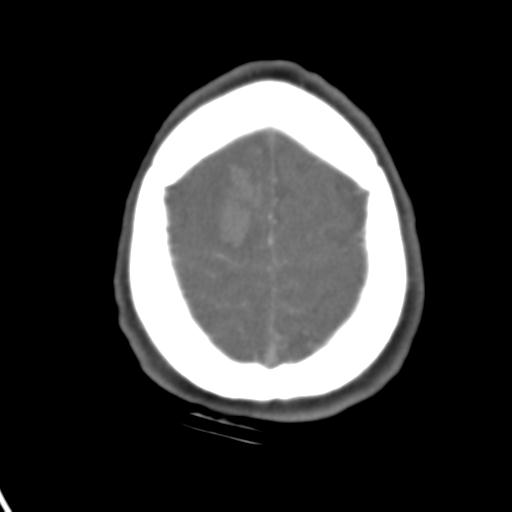 Cerebral arteriovenous malformation with hemorrhage (Radiopaedia 28773-29073 A 9).jpg
