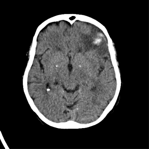 File:Cerebral arteriovenous malformation with lobar hemorrhage (Radiopaedia 44725-48510 Axial non-contrast 20).png