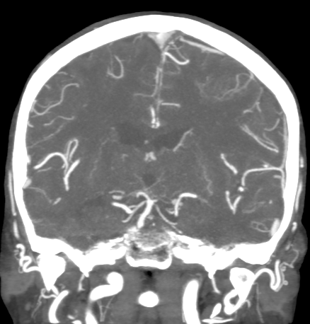 Cerebral arteriovenous malformation with lobar hemorrhage (Radiopaedia 44725-48511 B 30).png