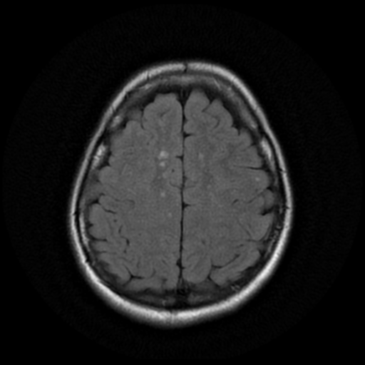 File:Cerebral autosomal dominant arteriopathy with subcortical infarcts and leukoencephalopathy (CADASIL) (Radiopaedia 41018-43768 AX FLAIR (Propeller) 16).png
