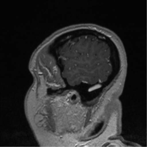 Cerebral cavernoma and development venous anomaly (Radiopaedia 37603-39482 Sagittal T1 C+ 83).png