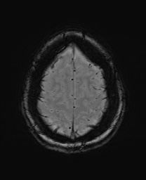Cerebral cavernous venous malformation (Radiopaedia 70008-80021 I 65).jpg
