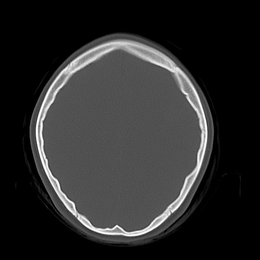 Cerebral cavernous venous malformation (Radiopaedia 70008-80022 Axial bone window 36).jpg