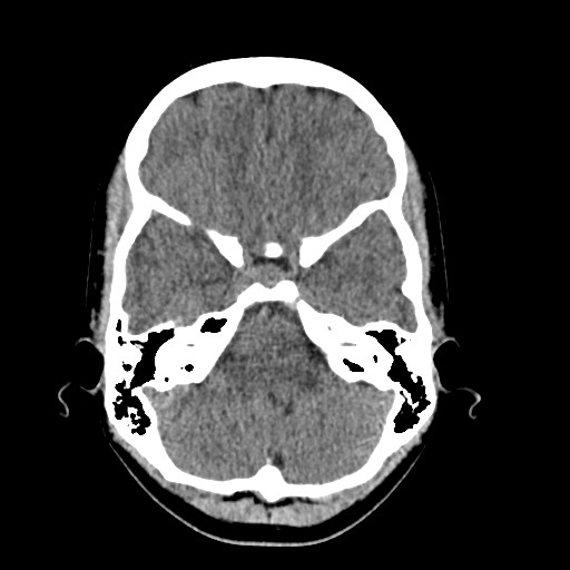 Cerebral cavernous venous malformation (Radiopaedia 70008-80022 Axial non-contrast 11).jpg