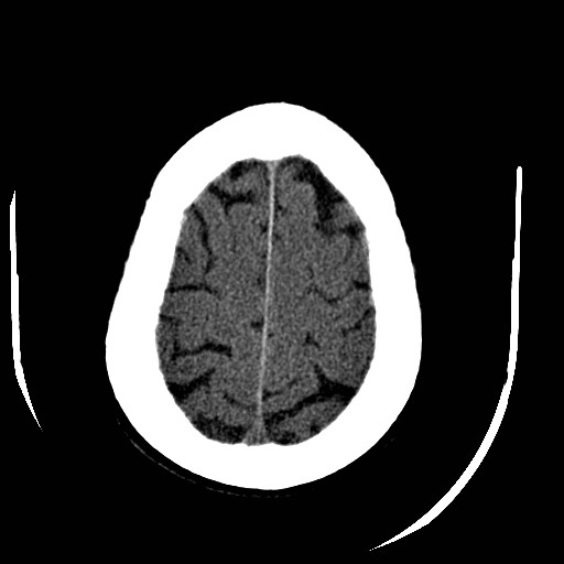 Cerebral edema (evolution in time) (Radiopaedia 19418-19440 non-contrast 80).jpg