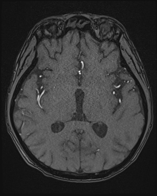 File:Cerebral embolic infarcts (embolic shower) (Radiopaedia 72391-82921 Axial MRA 91).jpg