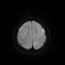 Cerebral metastases - melanoma (Radiopaedia 80972-94522 Axial DWI 25).jpg