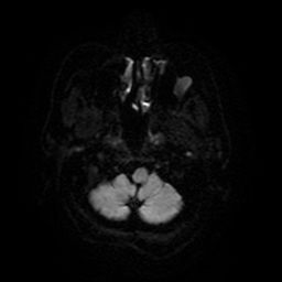 Cerebral metastases - melanoma (Radiopaedia 80972-94522 Axial DWI 5).jpg