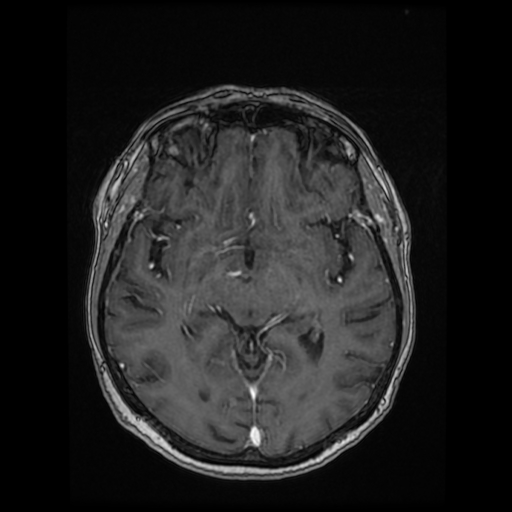 Cerebral metastases - melanoma (Radiopaedia 80972-94522 Axial T1 C+ 51).jpg