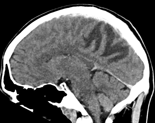 Cerebral metastases - testicular choriocarcinoma (Radiopaedia 84486-99855 F 28).jpg