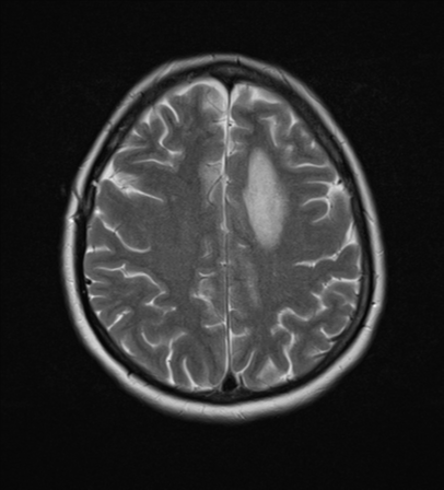 File:Cerebral metastases mimicking abscesses (Radiopaedia 45841-50131 Axial T2 21).png