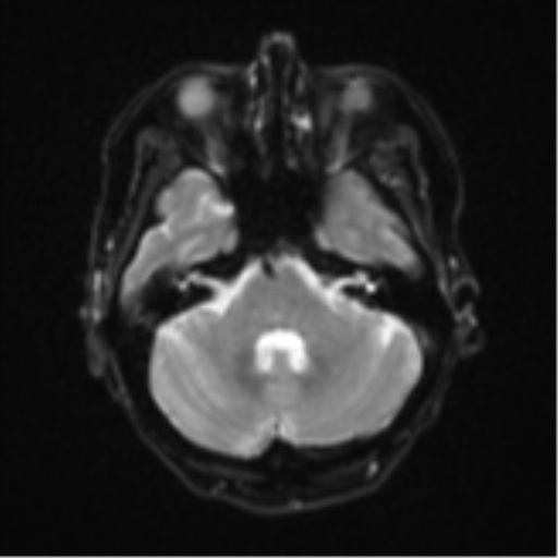 File:Cerebral metastasis (Radiopaedia 46744-51248 Axial DWI 7).png