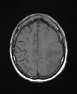 File:Cerebral metastasis (Radiopaedia 46744-51248 Axial T1 21).png