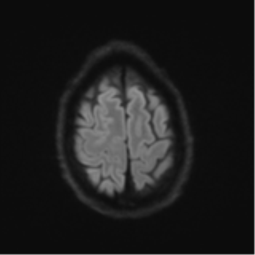 Cerebral metastasis - melanoma (Radiopaedia 54718-60954 Axial DWI 56).png
