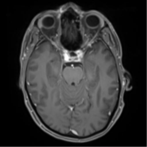 Cerebral metastasis - melanoma (Radiopaedia 54718-60954 Axial T1 C+ fat sat 20).png