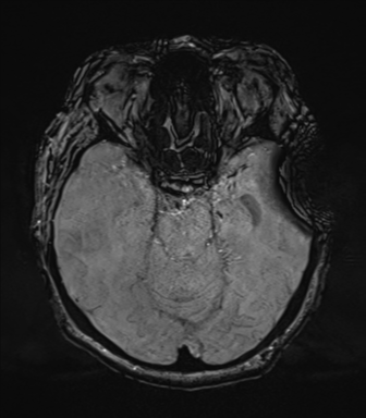 File:Cerebral metastasis to basal ganglia (Radiopaedia 81568-95413 Axial SWI 29).png
