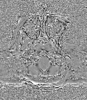 Cerebral metastasis to basal ganglia (Radiopaedia 81568-95413 Axial SWI phase 5).png