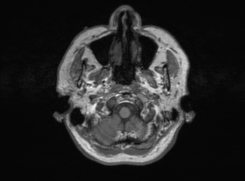 Cerebral ring enhancing lesions - cerebral metastases (Radiopaedia 44922-48817 Axial T1 350).jpg