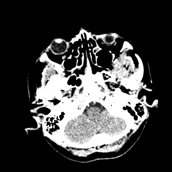 Cerebral ring enhancing lesions - cerebral metastases (Radiopaedia 44922-48818 B 46).jpg