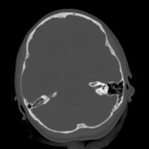 Cerebral tuberculosis with dural sinus invasion (Radiopaedia 60353-68018 Axial bone window 17).jpg