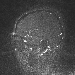 Cerebral tuberculosis with dural sinus invasion (Radiopaedia 60353-68090 Sagittal MRV 30).jpg