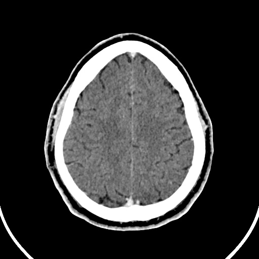 File:Cerebral venous angioma (Radiopaedia 69959-79977 B 82).jpg
