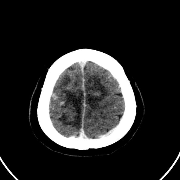 File:Cerebral venous hemorrhagic infarct from venous sinus thrombosis (Radiopaedia 55433-61883 Axial C+ delayed 23).jpg