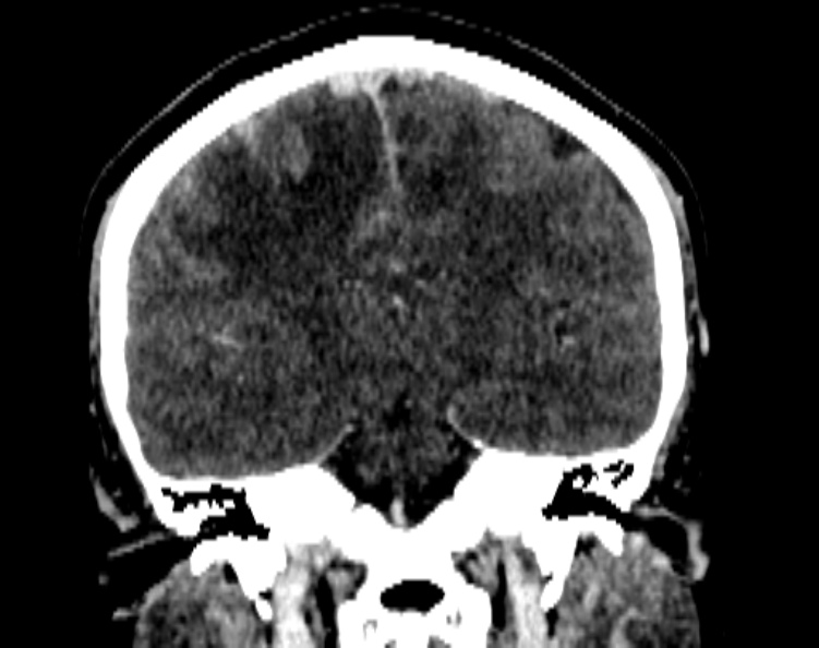 Cerebral venous hemorrhagic infarct from venous sinus thrombosis (Radiopaedia 55433-61883 Coronal C+ delayed 35).jpg