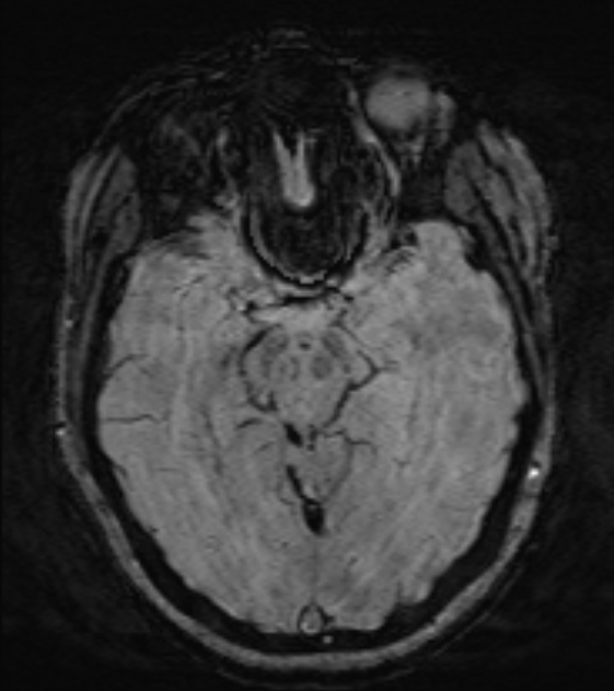 Cerebral venous infarct (Radiopaedia 53627-59685 Axial SWI 22).jpg