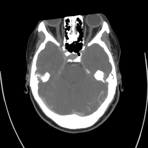 File:Cerebral venous infarct related to dural venous sinus thromboses (Radiopaedia 35292-36804 Axial C+ delayed 17).png