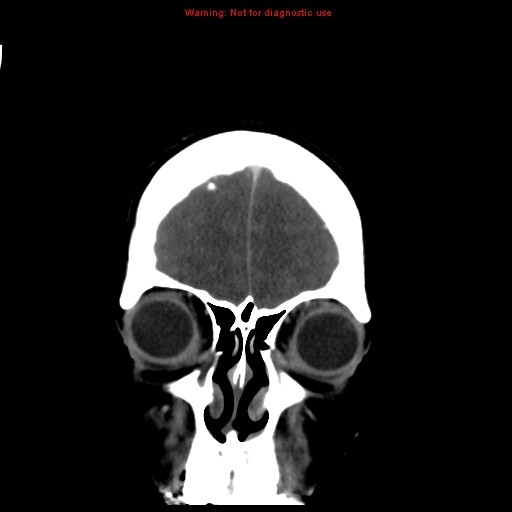 Cerebral venous infarction (Radiopaedia 12404-20735 B 10).jpg