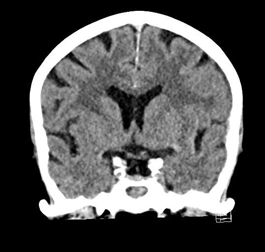 Cerebral venous infarction with hemorrhage (Radiopaedia 65343-74381 Coronal non-contrast 21).jpg