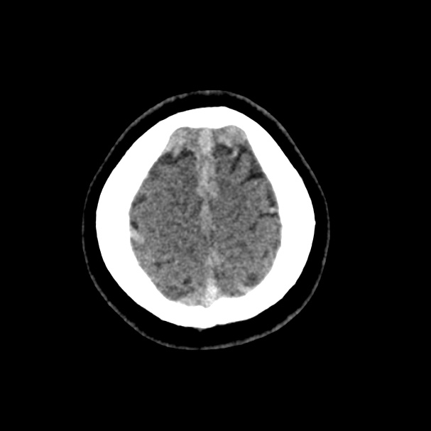 Cerebral venous sinus thrombosis (Radiopaedia 59224-66551 Axial non-contrast 51).jpg
