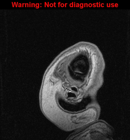 File:Cerebral venous thrombosis (Radiopaedia 37224-39208 Sagittal T1 C+ 148).jpg