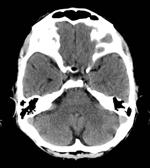 File:Cerebral venous thrombosis (Radiopaedia 38392-40467 Axial non-contrast 8).png