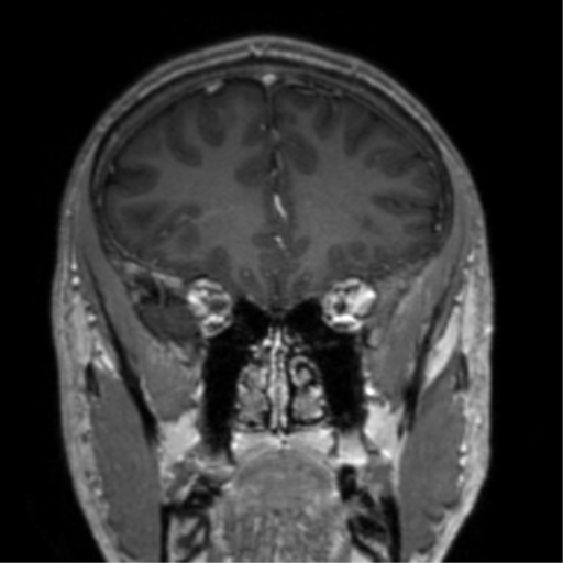Cerebral venous thrombosis (Radiopaedia 38392-40469 Coronal T1 C+ 66).png