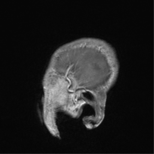 Cerebral venous thrombosis (Radiopaedia 38392-40469 Sagittal T1 C+ 9).png