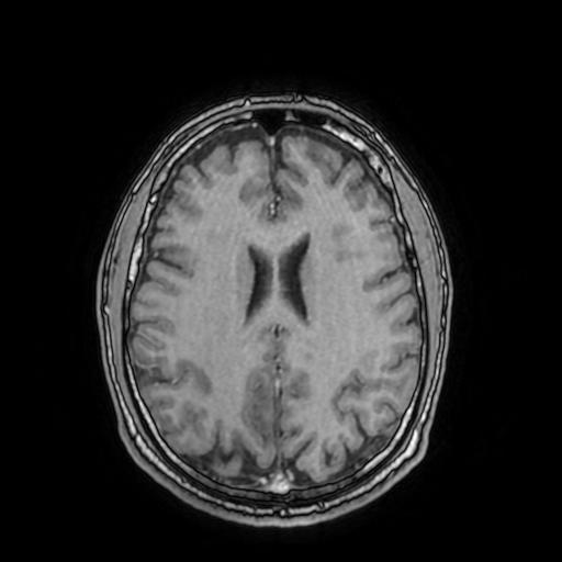 File:Cerebral venous thrombosis with secondary intracranial hypertension (Radiopaedia 89842-106957 Axial T1 C+ 115).jpg