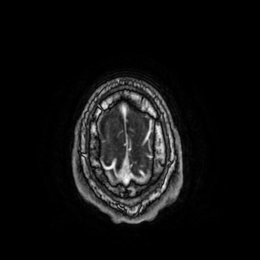 File:Cerebral venous thrombosis with secondary intracranial hypertension (Radiopaedia 89842-106957 Axial T1 C+ 158).jpg