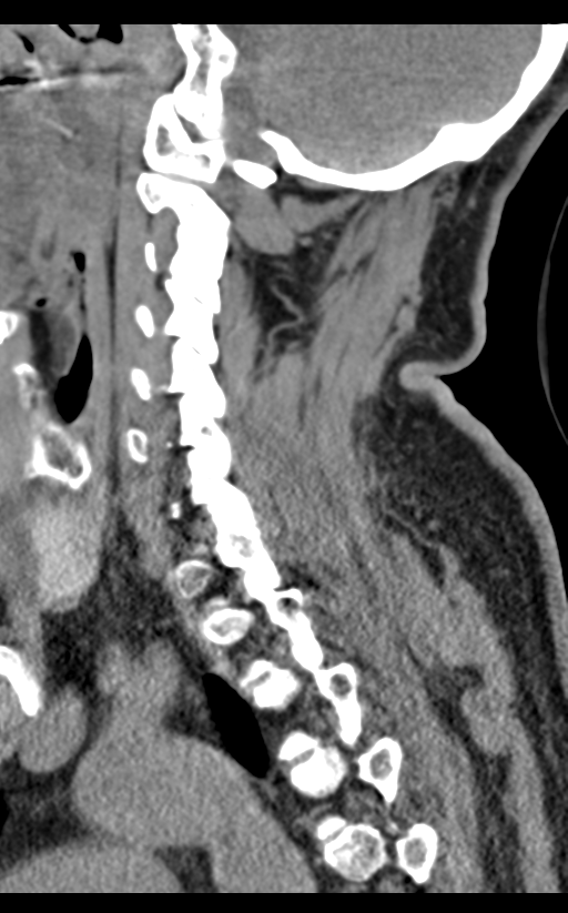 Cervical canal stenosis due to ossification of the posterior longitudinal ligament (Radiopaedia 47260-51823 D 28).png
