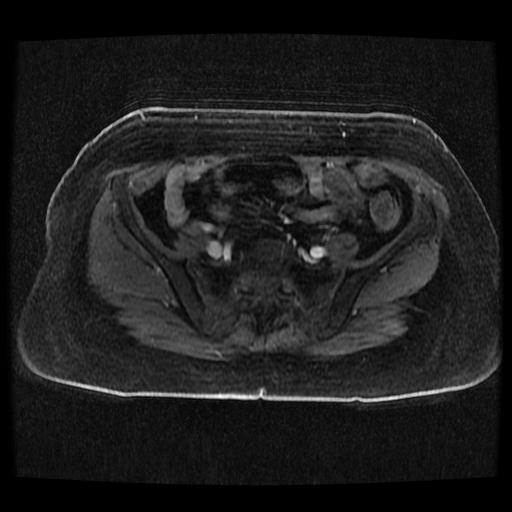 Cervical carcinoma (Radiopaedia 70924-81132 Axial T1 C+ fat sat 160).jpg