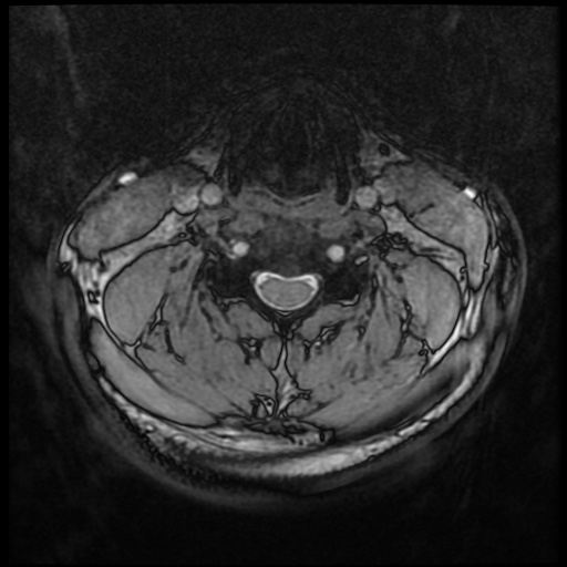 Cervical disc extrusion (Radiopaedia 59074-66364 G 45).jpg