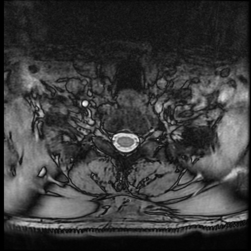Cervical disc extrusion (Radiopaedia 59074-66364 G 96).jpg