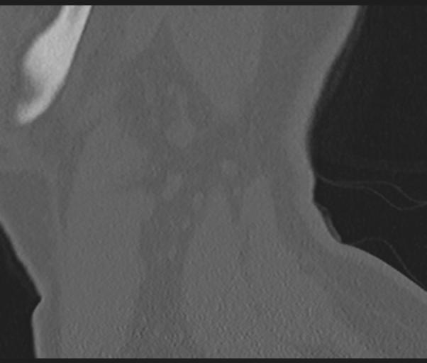 Cervical disc replacement (Radiopaedia 44025-47541 Sagittal bone window 76).png