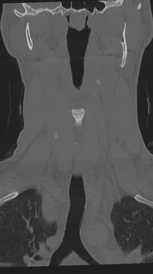 Cervical intercalary bone (Radiopaedia 35211-36748 Coronal bone window 24).png